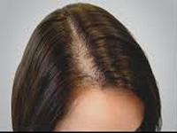 PRP therapy is a treatment for hair loss